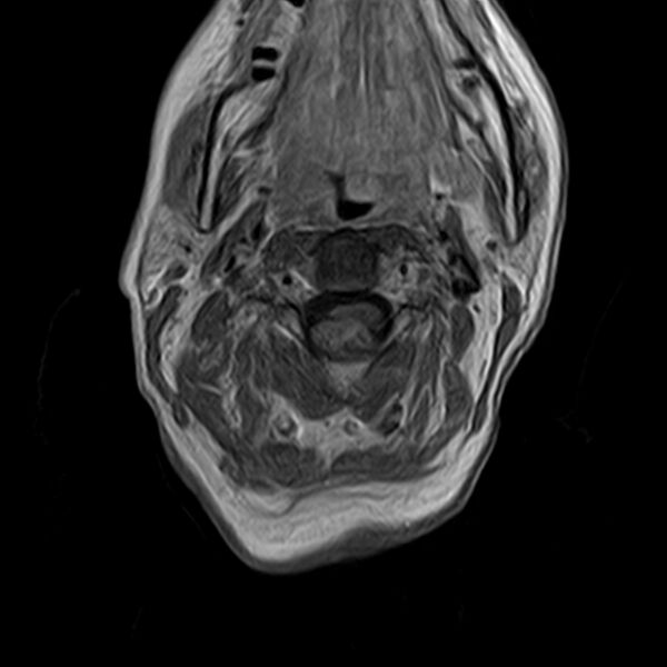File:Calcified meningioma - cervical canal (Radiopaedia 70136-82468 Axial T1 C+ 12).jpg