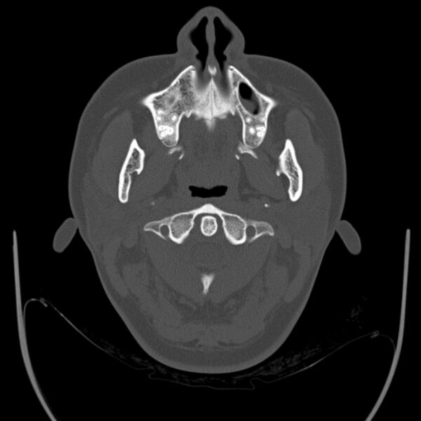File:Calvarial osteoma (Radiopaedia 36520-38079 Axial bone window 1).jpg