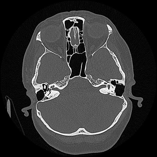 File:Canal up mastoidectomy (Radiopaedia 78108-90638 Axial bone window 78).jpg