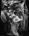 Cancer cervix - stage IIb (Radiopaedia 75411-86615 Sagittal ADC 19).jpg