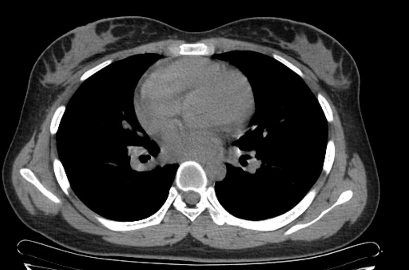 File:Cannonball metastases - uterine choriocarcinoma (Radiopaedia 70137-80173 Axial non-contrast 62).jpg