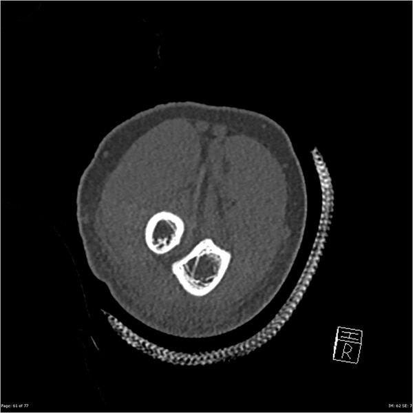 File:Capitellum fracture (Radiopaedia 23352-23426 Coronal bone window 61).jpg