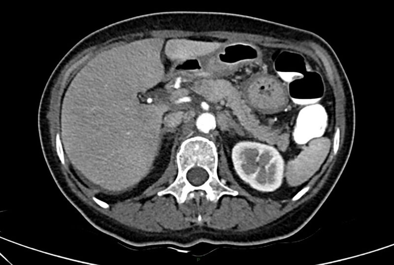 File:Carcinoid mesenteric tumor complicated by chylous ascites (Radiopaedia 76312-88926 A 21).jpg
