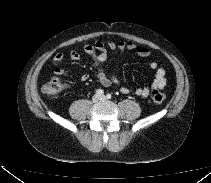 File:Carcinoid tumor with hepatic metastases (Radiopaedia 22651-22670 C 57).jpg