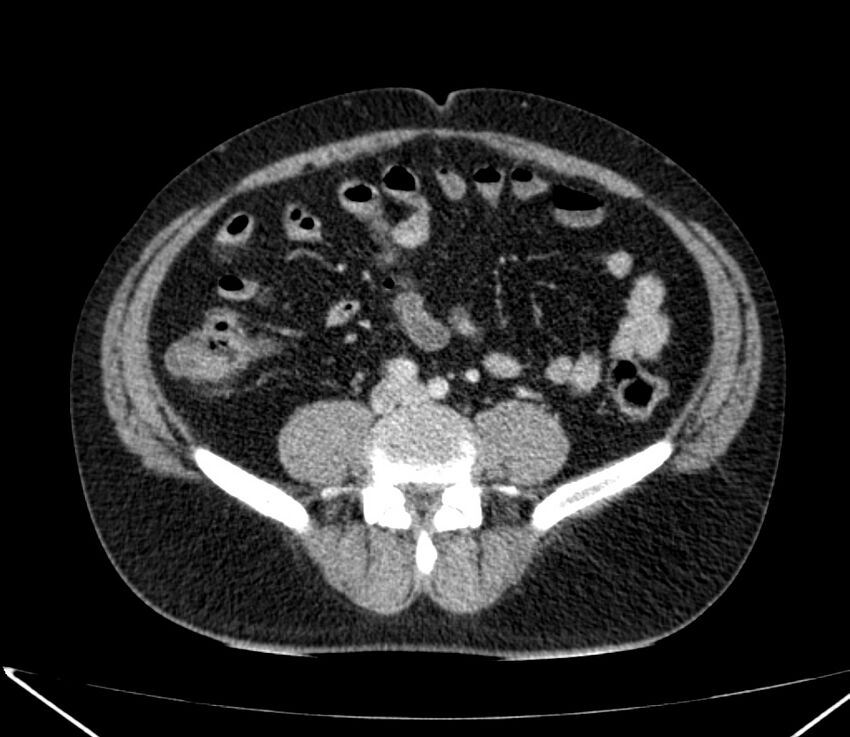 Carcinoid tumor with hepatic metastases (Radiopaedia 22651-22670 C 57).jpg