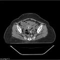 Carcinoma cervix- brachytherapy applicator (Radiopaedia 33135-34173 Axial non-contrast 22).jpg