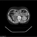 Carcinoma cervix- recurrence (Radiopaedia 34702-36137 B 69).jpg