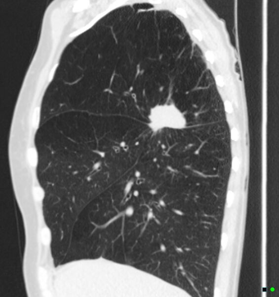 File:Carcinoma of the lung (Radiopaedia 17945-17705 Sagittal lung window 1).jpg