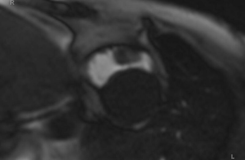 File:Cardiac hemangioma (Radiopaedia 31709-32631 Short axis 100).jpg