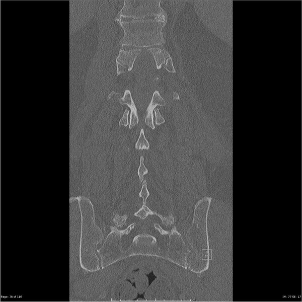 File:Cardiac trauma (Radiopaedia 32874-33858 Coronal bone window 76).jpg