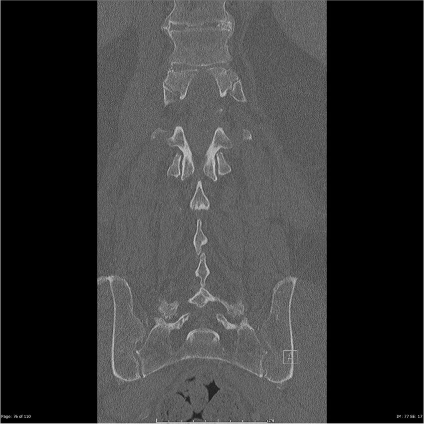 Cardiac trauma (Radiopaedia 32874-33858 Coronal bone window 76).jpg