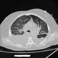 Cardiogenic pulmonary edema (Radiopaedia 29213-29609 Axial lung window 33).jpg