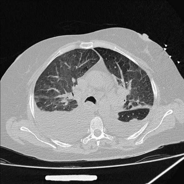File:Cardiogenic pulmonary edema (Radiopaedia 29213-29609 Axial lung window 33).jpg