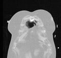 Cardiogenic pulmonary edema (Radiopaedia 29213-29609 Coronal lung window 5).jpg