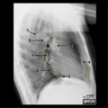 Cardiomediastinal anatomy on chest radiography (annotated images) (Radiopaedia 46331-50747 B 1).png