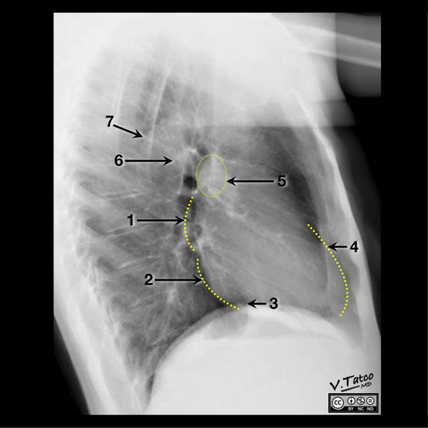 File:Cardiomediastinal anatomy on chest radiography (annotated images) (Radiopaedia 46331-50747 B 1).png