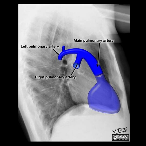 File:Cardiomediastinal anatomy on chest radiography (annotated images) (Radiopaedia 46331-50748 Q 4).jpeg