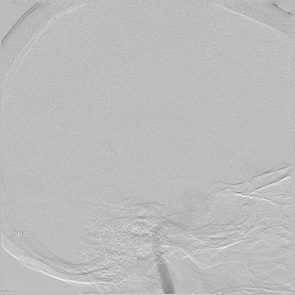 File:Caroticocavernous fistula (direct) (Radiopaedia 23501-23586 RT ICA LAT 1).jpg