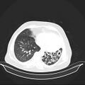 Carotid body tumor (Radiopaedia 21021-20948 Axial lung window 30).jpg
