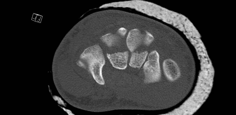 File:Carpal fractures (smart watch impaction) (Radiopaedia 55844-62430 Axial bone window 39).jpg