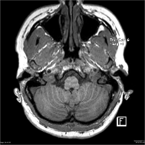 File:Cavernous malformation (cavernous angioma or cavernoma) (Radiopaedia 36675-38237 Axial T1 15).jpg