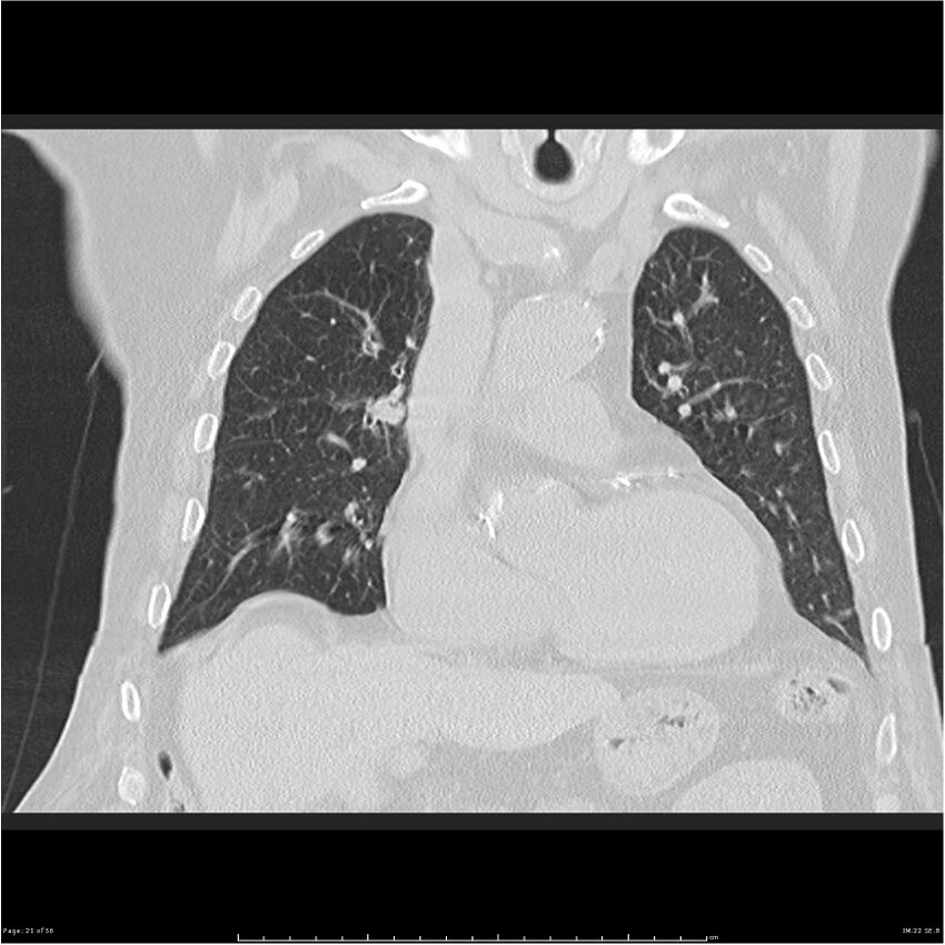 Cavitating left lower lobe lesion - squamous cell lung cancer (Radiopaedia 27749-28176 Coronal lung window 21).jpg