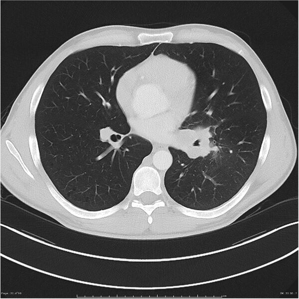 File:Cavitating lung cancer (Radiopaedia 25796-25945 Axial lung window 31).jpg