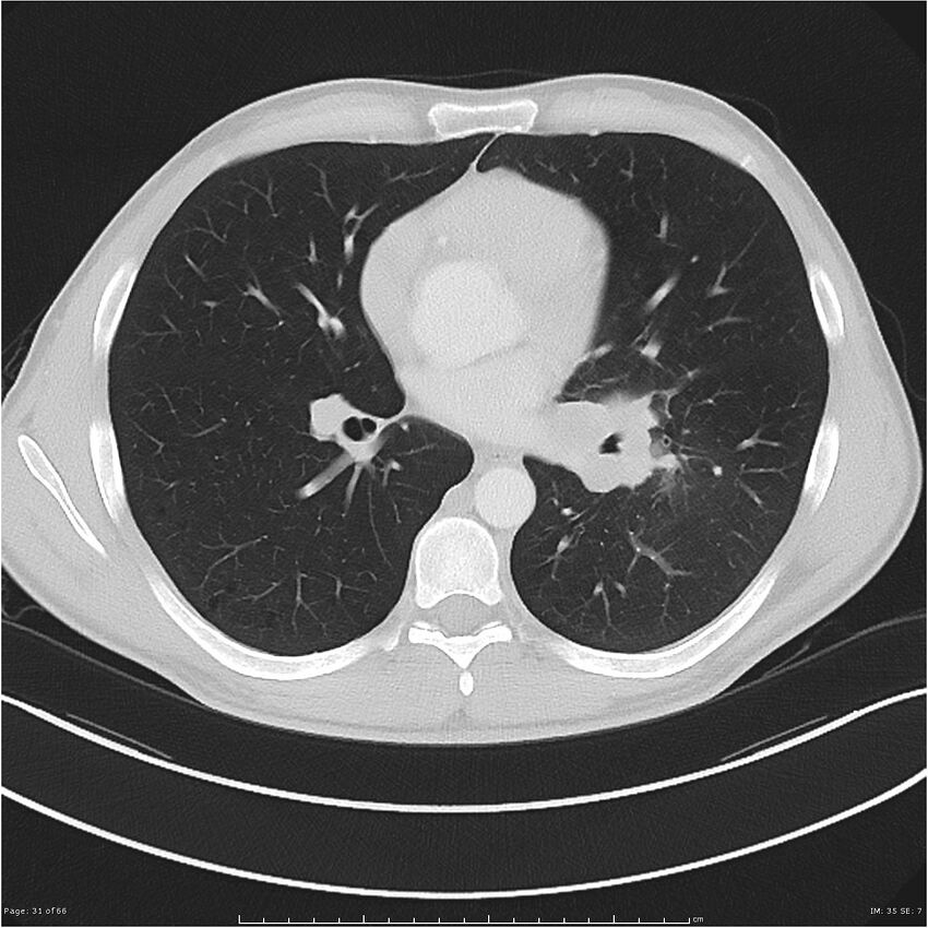 Cavitating lung cancer (Radiopaedia 25796-25945 Axial lung window 31).jpg