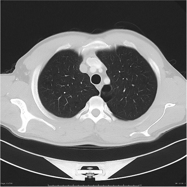 File:Cavitating lung cancer (Radiopaedia 25796-25945 Axial lung window 9).jpg