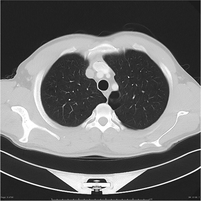 Cavitating lung cancer (Radiopaedia 25796-25945 Axial lung window 9).jpg