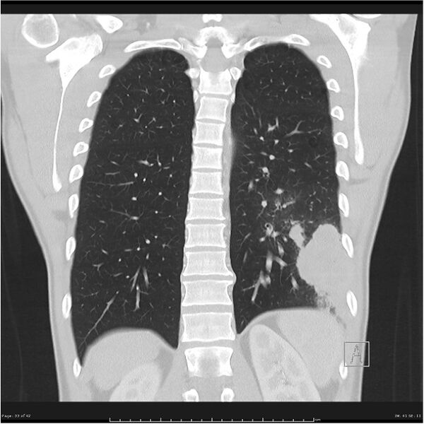 File:Cavitating lung cancer (Radiopaedia 25796-25945 lung window 33).jpg