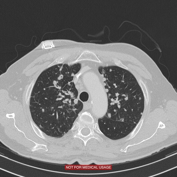 File:Cavitating pulmonary metastases (Radiopaedia 24920-25184 Axial lung window 5).jpg