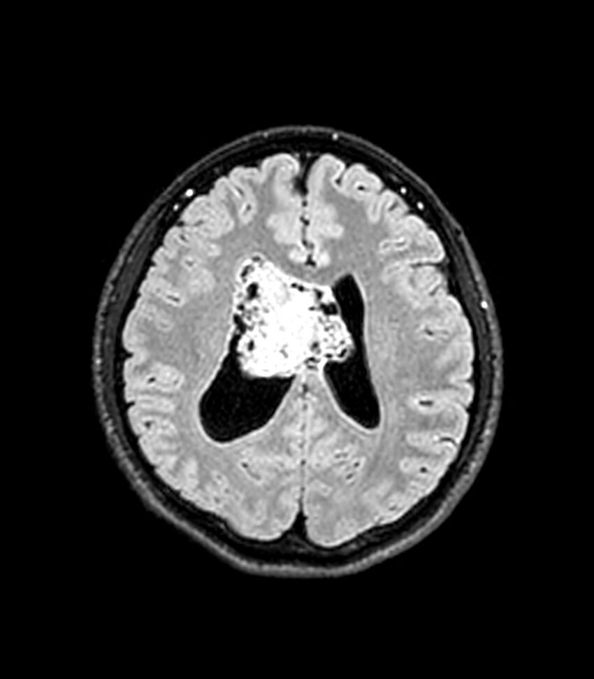 Central neurocytoma (Radiopaedia 79320-92380 Axial FLAIR 121).jpg
