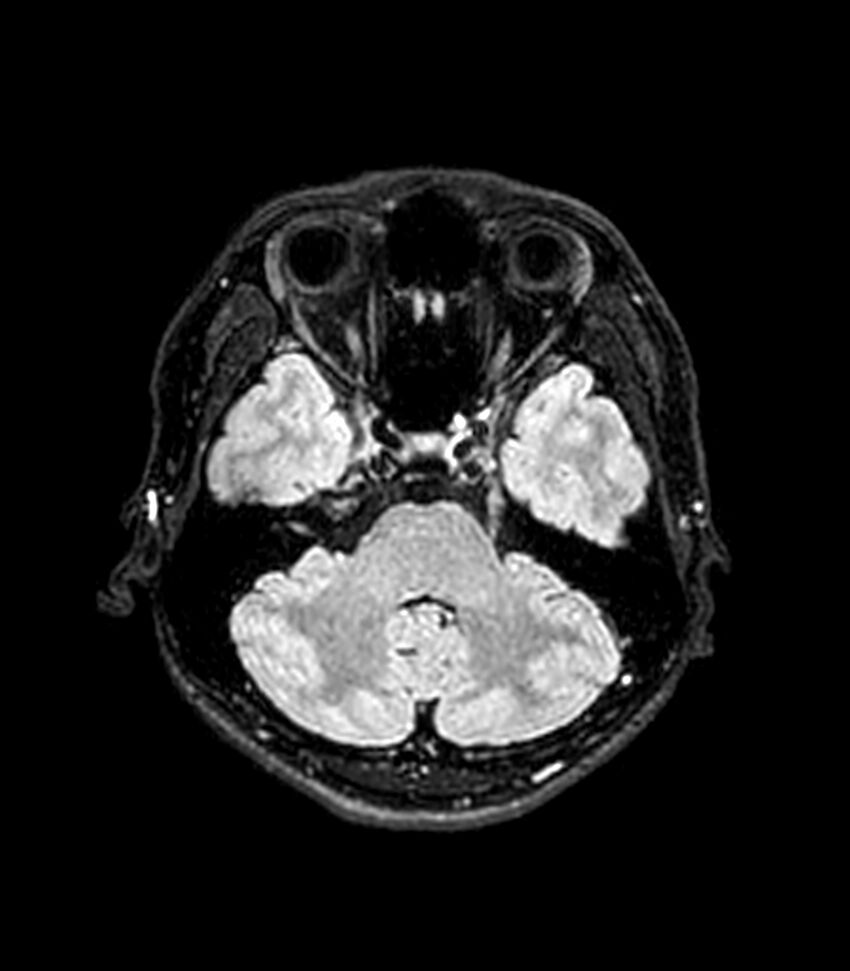 Central neurocytoma (Radiopaedia 79320-92380 Axial FLAIR 223).jpg