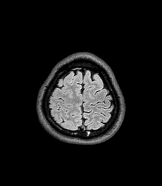 File:Central neurocytoma (Radiopaedia 79320-92380 Axial FLAIR 57).jpg