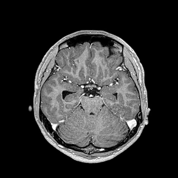 File:Central neurocytoma (Radiopaedia 79320-92380 Axial T1 C+ 97).jpg