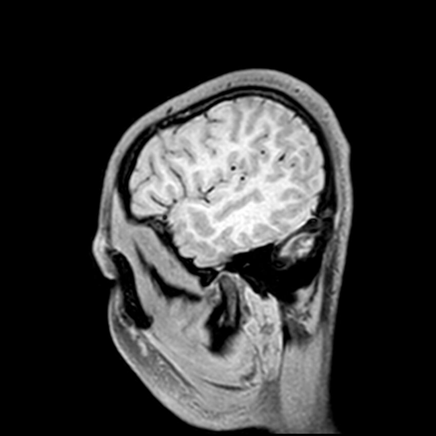 Central neurocytoma (Radiopaedia 79320-92380 Sagittal T1 48).jpg