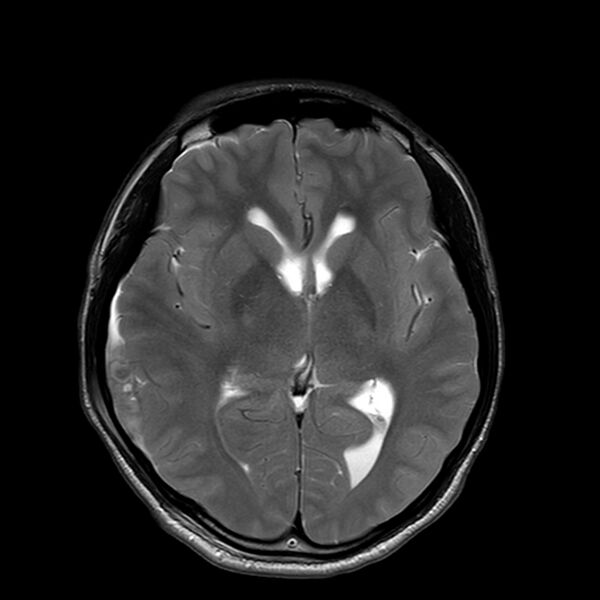 File:Central neurocytoma (Radiopaedia 79320-92381 Axial T2 13).jpg