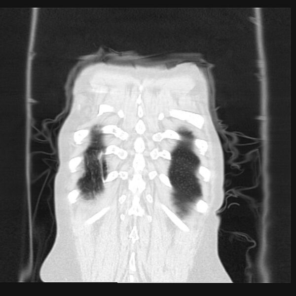 File:Centrilobular pulmonary emphysema (Radiopaedia 24495-24789 Coronal lung window 72).jpg