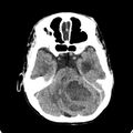 Cerebellar abscess secondary to mastoiditis (Radiopaedia 26284-26412 Axial non-contrast 46).jpg