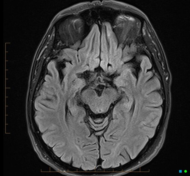 File:Cerebellar gangliocytoma (Radiopaedia 65377-74422 Axial FLAIR 16).jpg