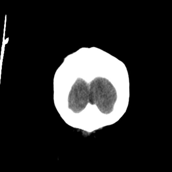 File:Cerebellar hemorrhage causing obstructive hydrocephalus (Radiopaedia 33989-35207 Coronal non-contrast 52).jpg