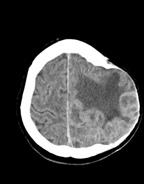 File:Cerebral abscesses (Radiopaedia 70458-80568 Axial 34).jpg