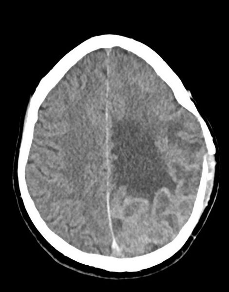 File:Cerebral abscesses (Radiopaedia 70458-80568 Axial non-contrast 43).jpg