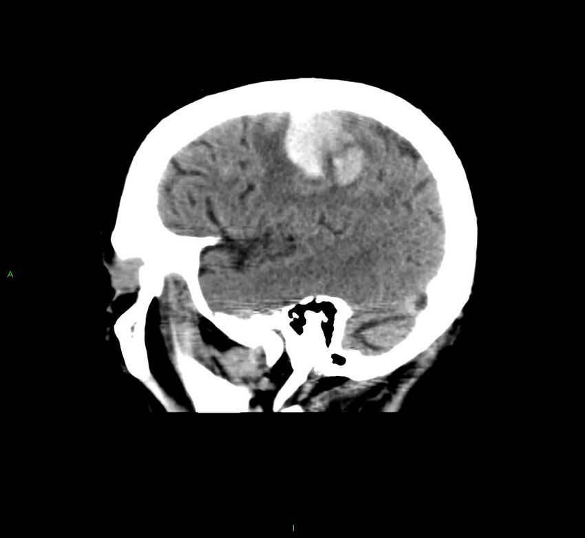 Cerebral amyloid angiopathy-associated lobar intracerebral hemorrhage (Radiopaedia 58376-65511 C 42).jpg