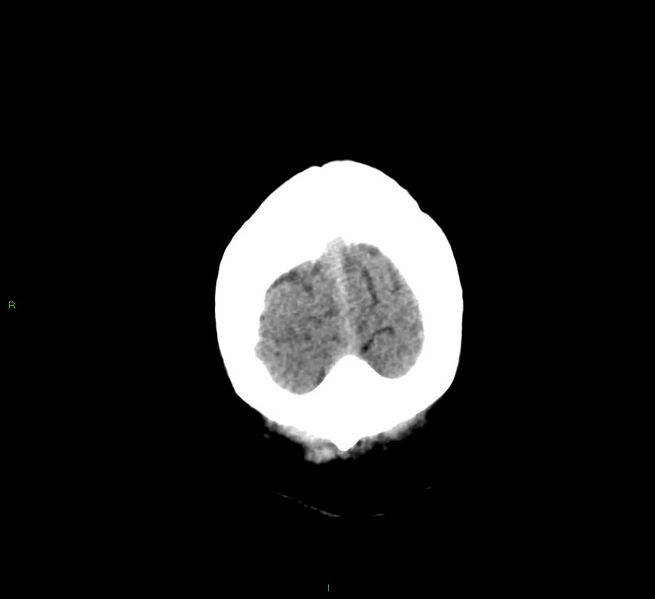 File:Cerebral amyloid angiopathy-associated lobar intracerebral hemorrhage (Radiopaedia 58376-65511 Coronal non-contrast 7).jpg