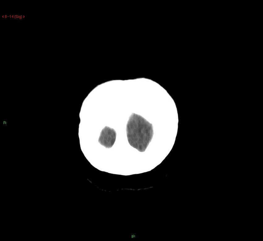 Cerebral amyloid angiopathy-associated lobar intracerebral hemorrhage (Radiopaedia 58378-65518 Coronal non-contrast 14).jpg