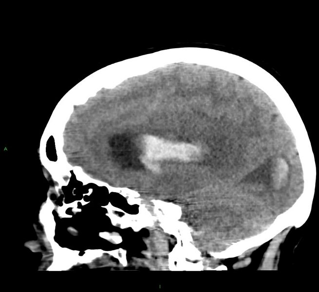 File:Cerebral amyloid angiopathy-associated lobar intracerebral hemorrhage (Radiopaedia 58379-65519 C 32).jpg