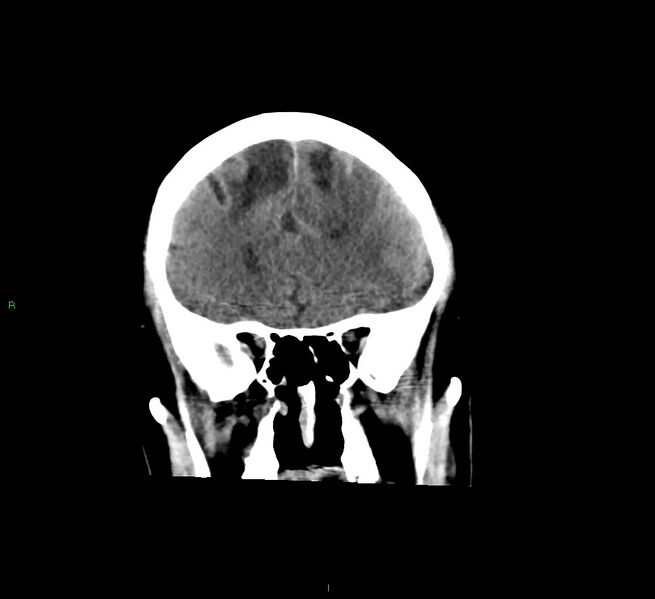 File:Cerebral amyloid angiopathy-associated lobar intracerebral hemorrhage (Radiopaedia 58529-65681 Coronal non-contrast 48).jpg