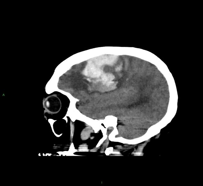 File:Cerebral amyloid angiopathy-associated lobar intracerebral hemorrhage (Radiopaedia 58560-65723 C 14).jpg